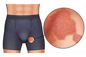 Schistomatosis insan cinsel organlarını etkileyerek şiddetli kaşıntıya neden olur