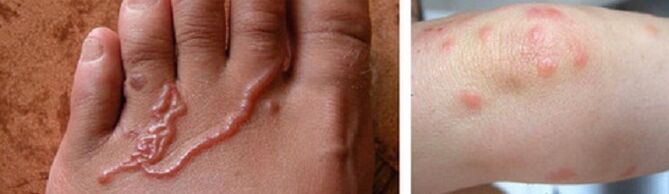 insan derisinin altındaki solucanlar